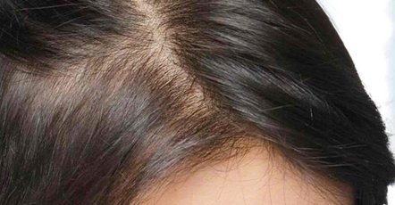 Alopecia Androgenetica Femminile