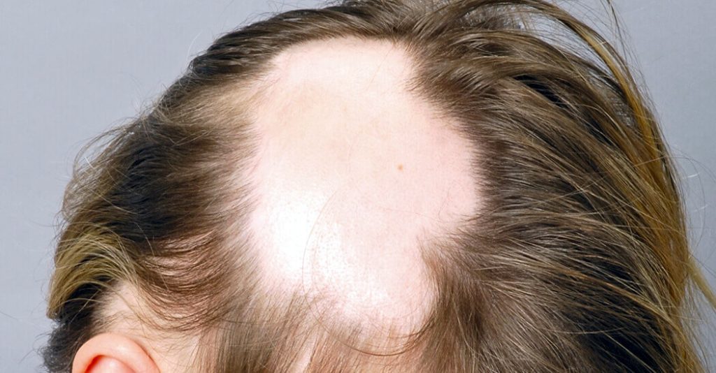 Si guarisce dallalopecia areata